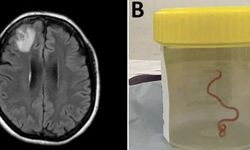 Tıp literatüründe ilk: Avustralya'da bir kadının beyninden canlı solucan çıkarıldı